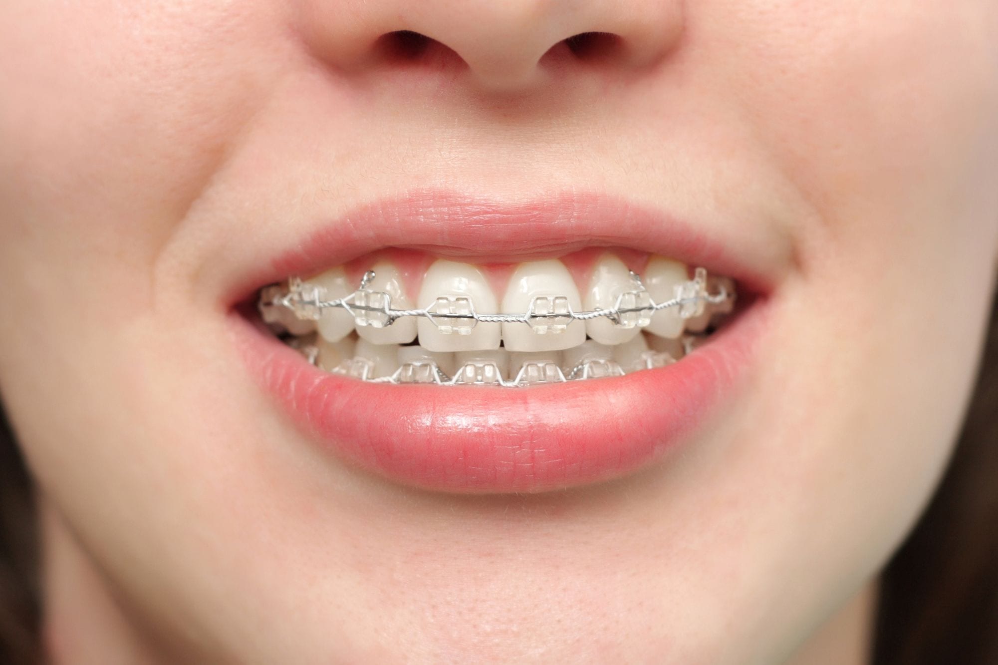Clear / Ceramic Braces  Tooth-colored Braces in Lisle, IL